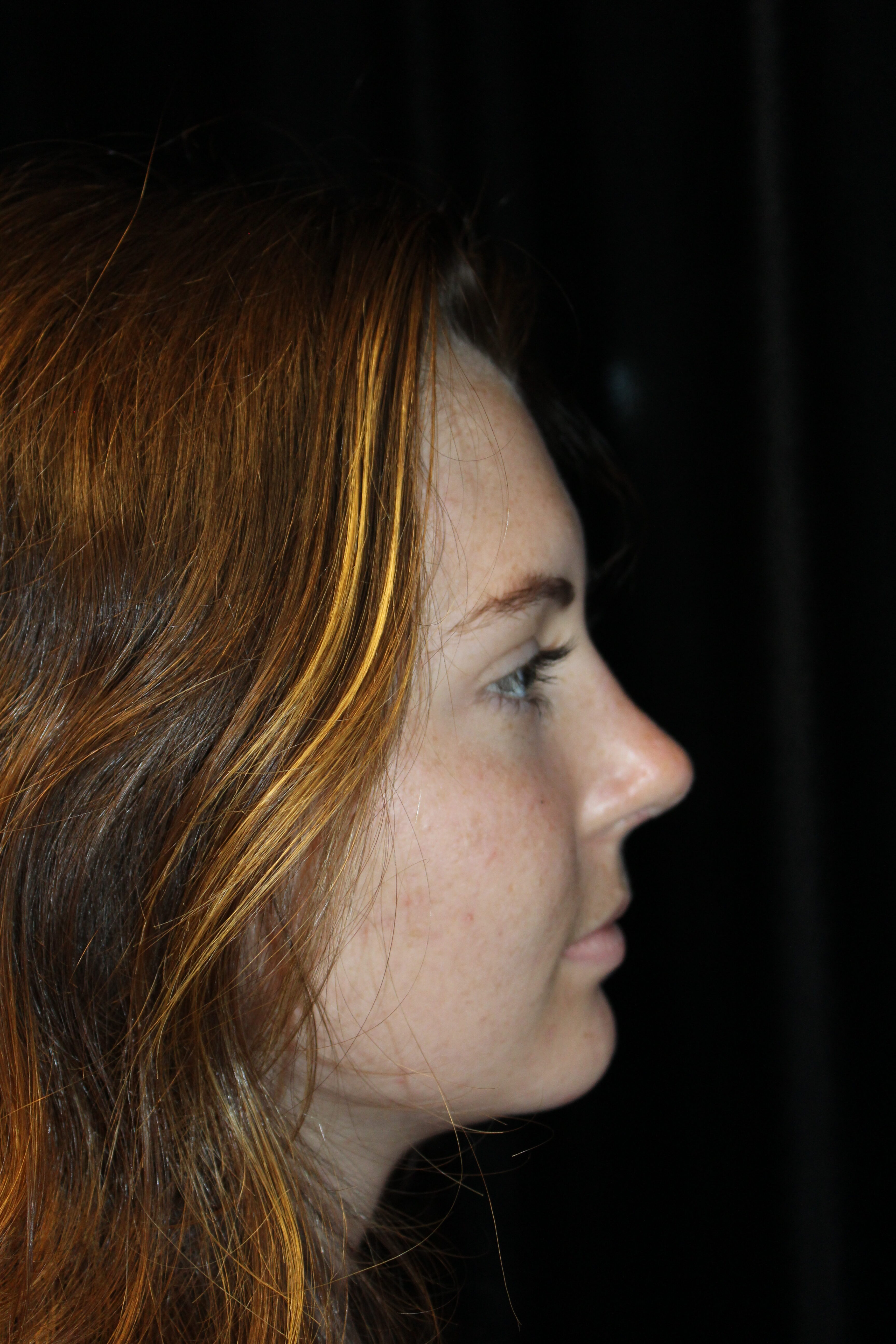 After Rhinoplasty Treatment