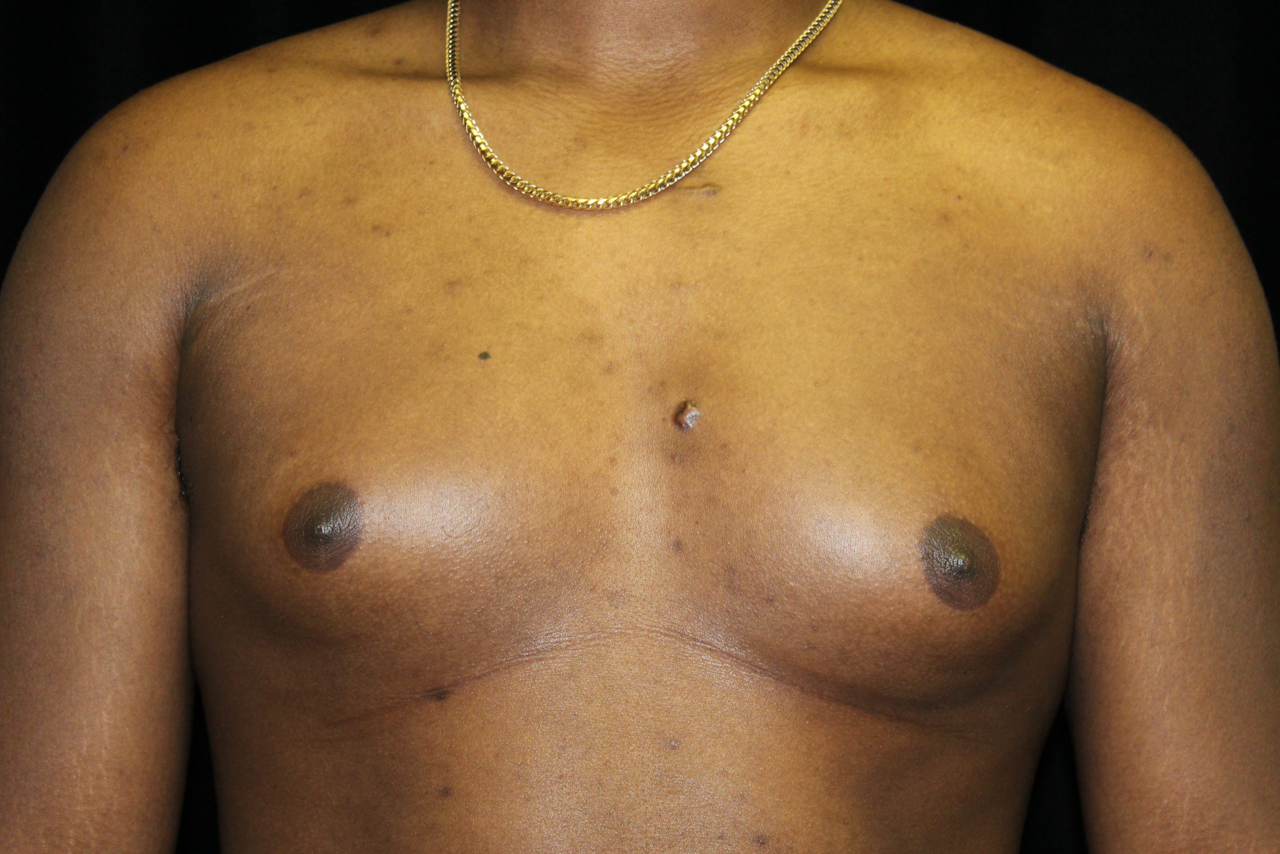 Before Gynecomastia Treatment