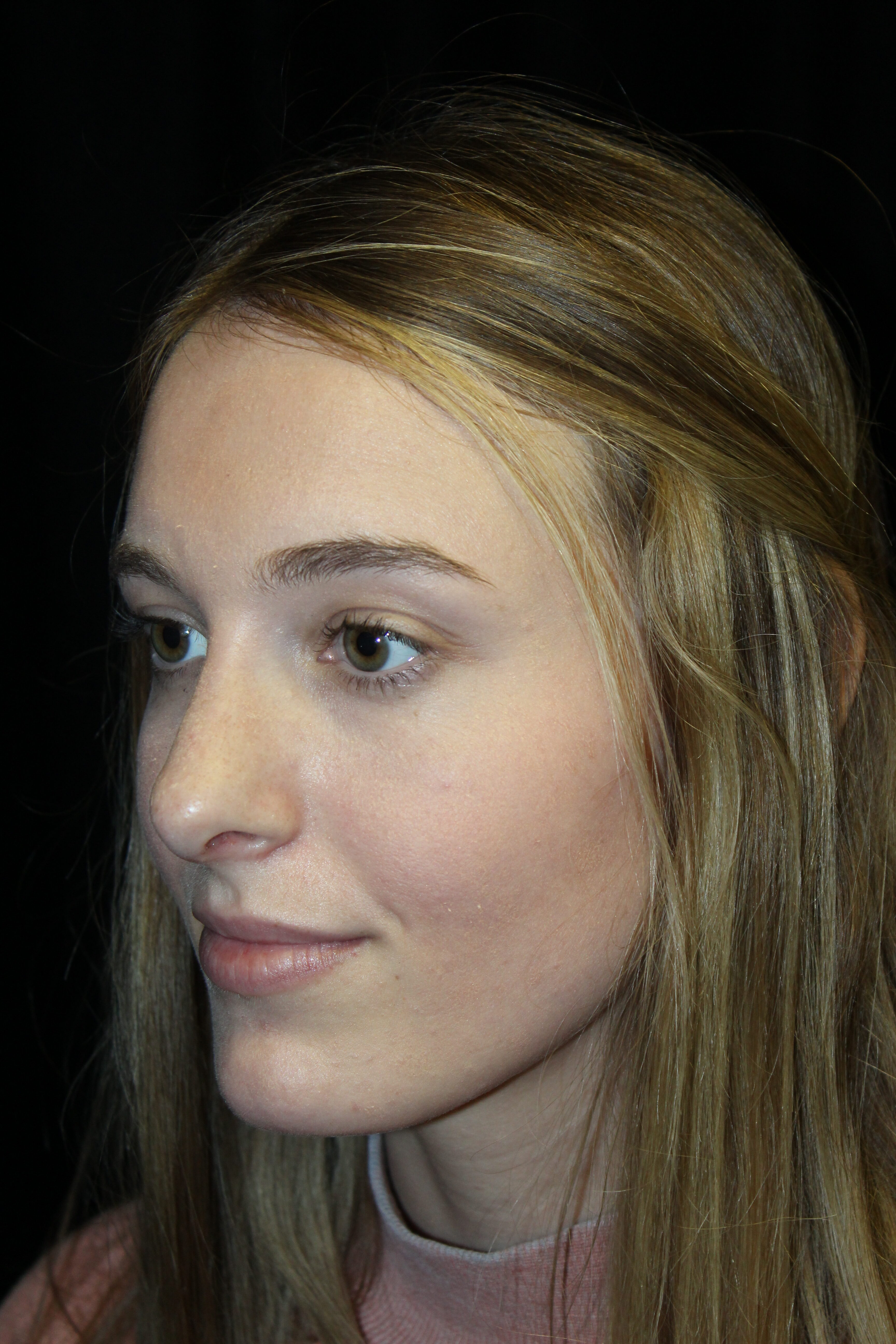 Before Rhinoplasty