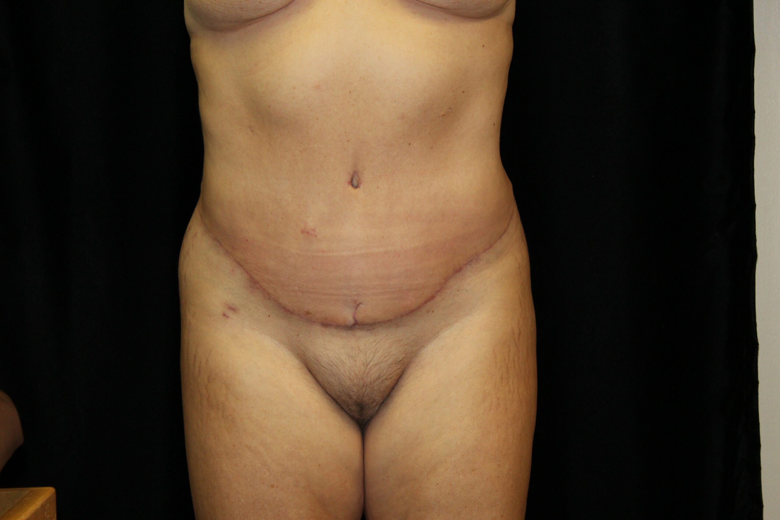 After Abdominoplasty Treatment