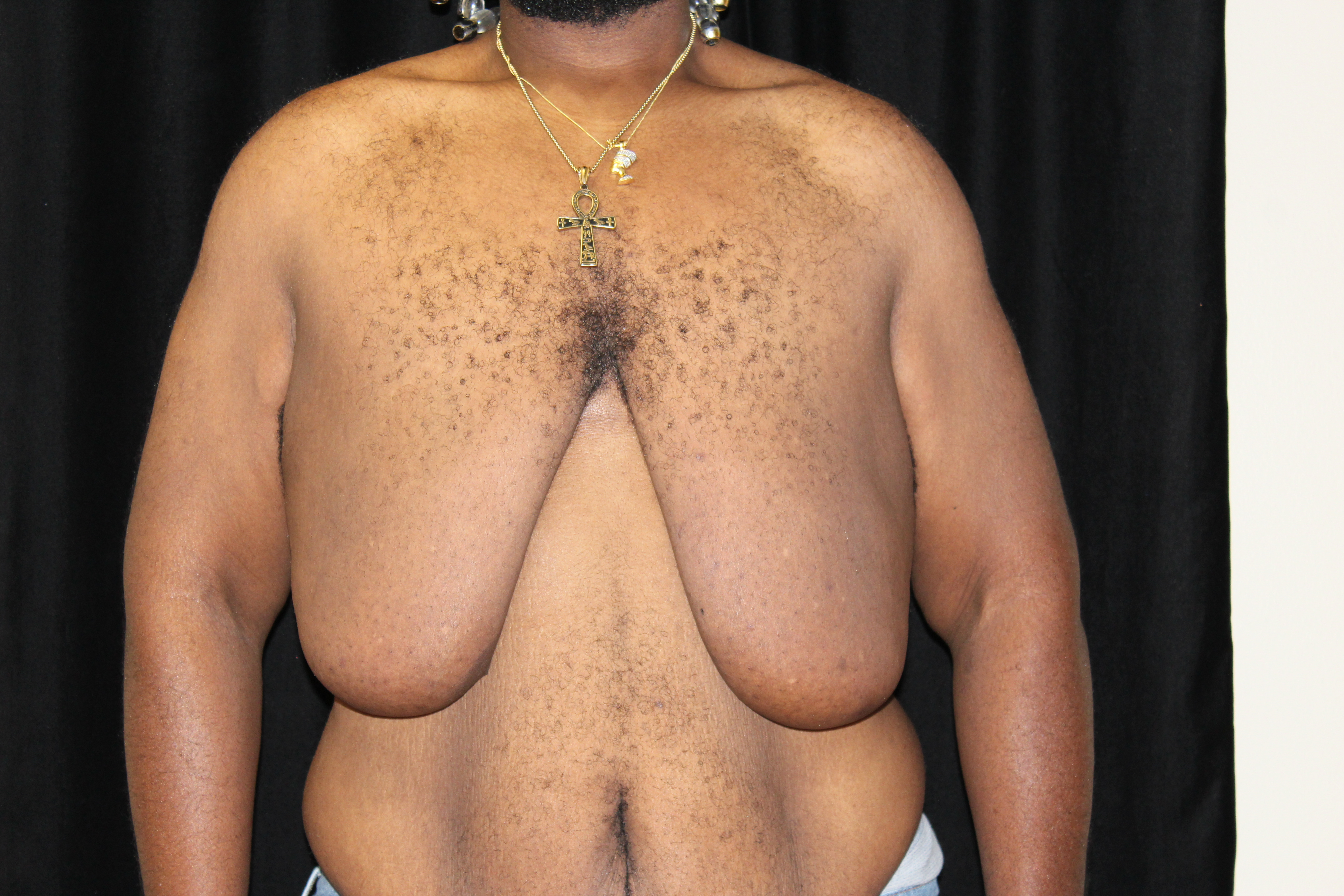 Before Breast Reduction Procedure