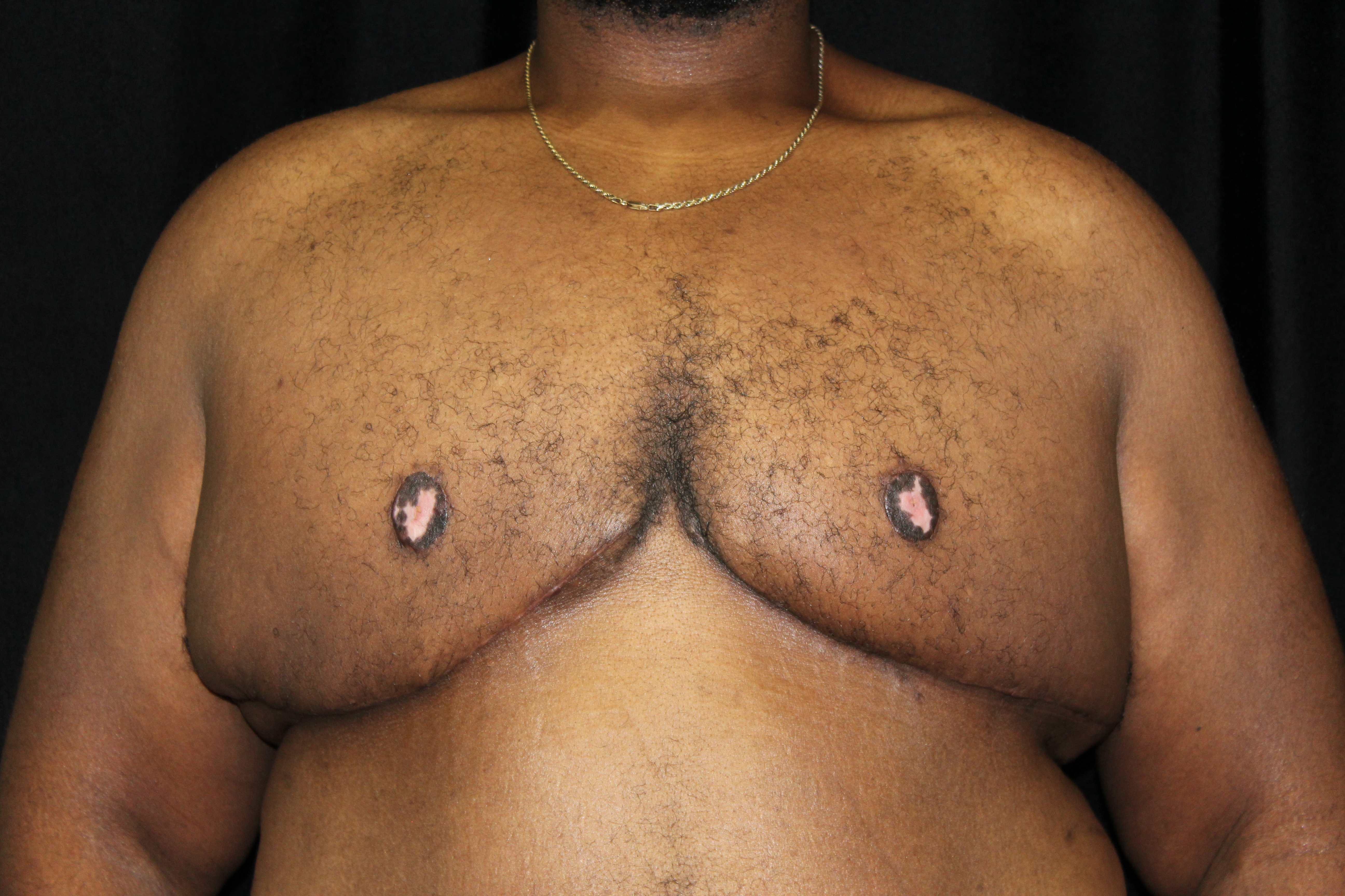 After Breast Reduction Procedure